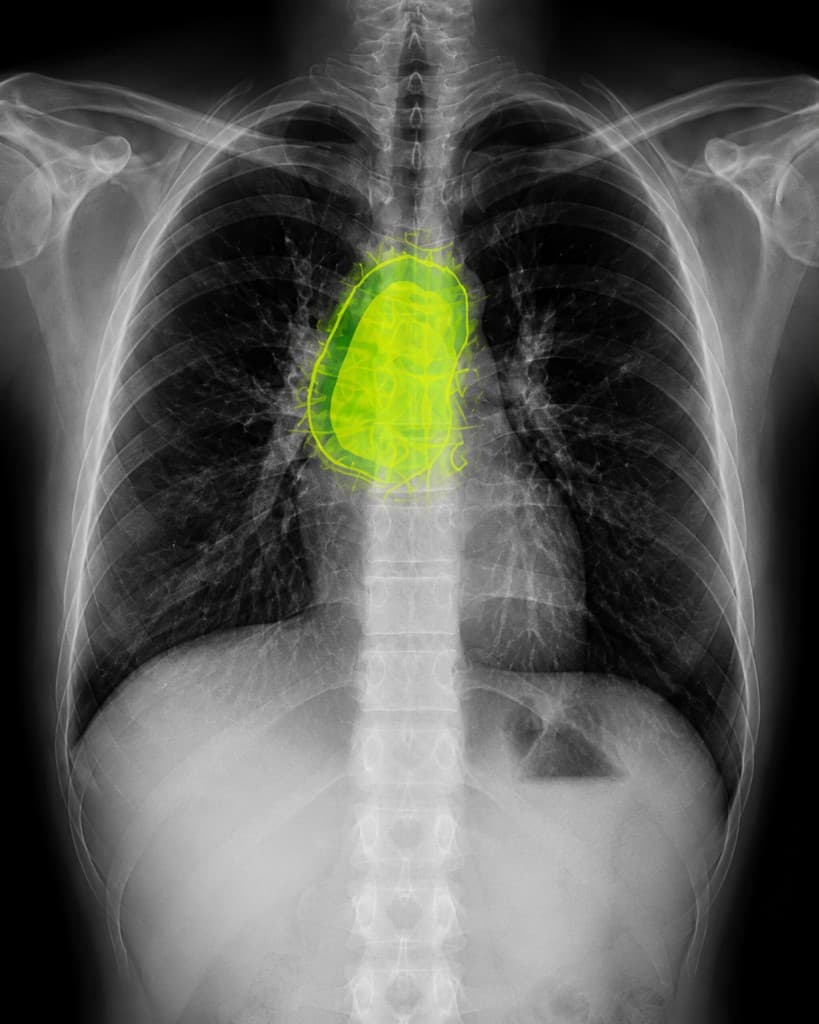 Chest X-ray with mediastinal tumour highlighted in lime green
